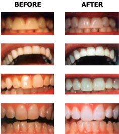 Teeth whitening - before and after